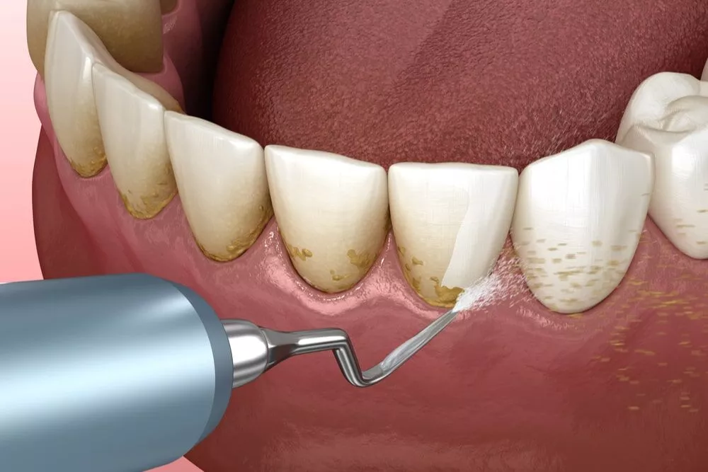 The Cost of Dental Cleaning Orem, Utah