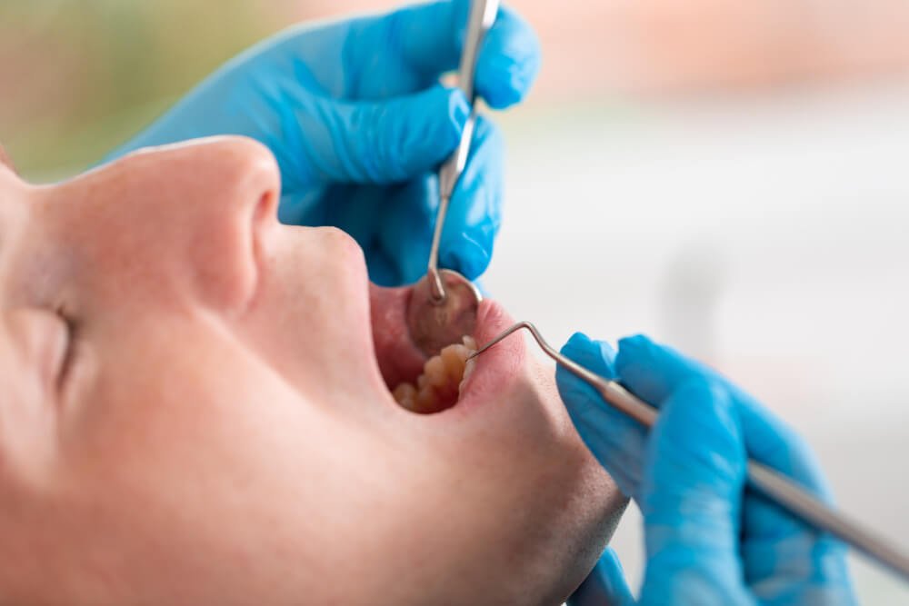 Dental Fillings Cost in Orem