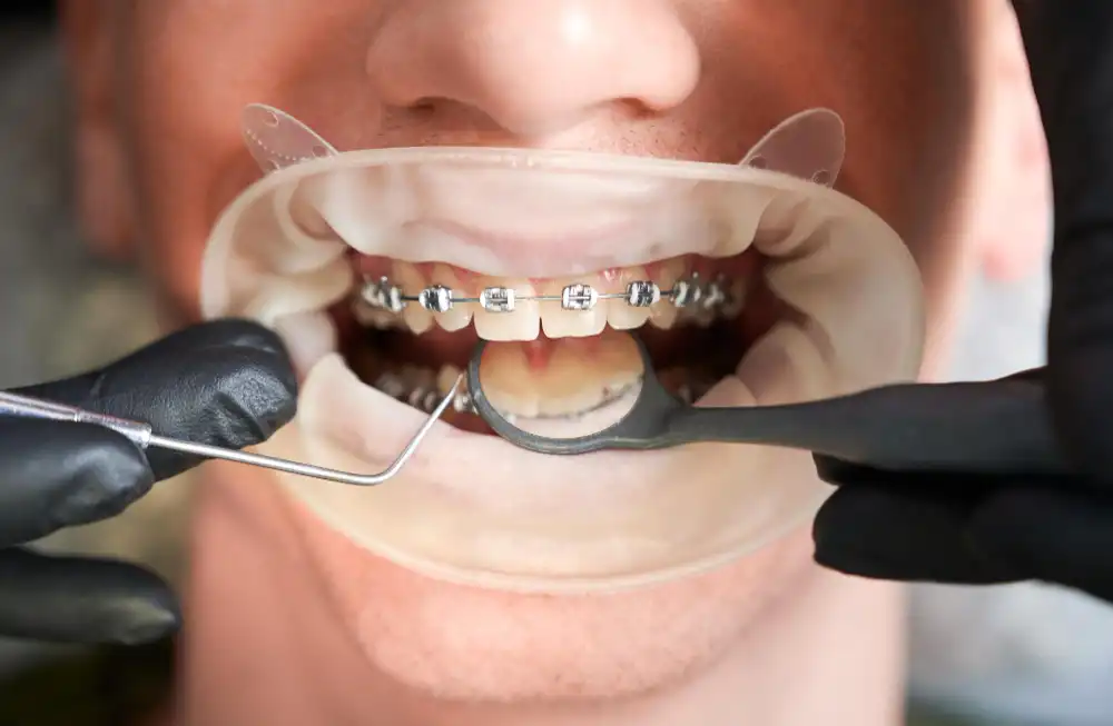 Treatment Options to Fix Long Teeth