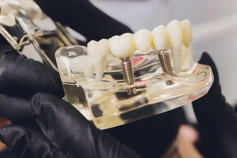 Key Differences Between Dental Implant vs Dentures