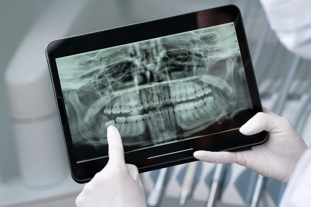 What Are Extraoral X-rays