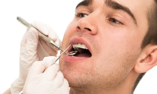 Root Canal