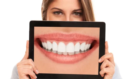 Teeth Whitening